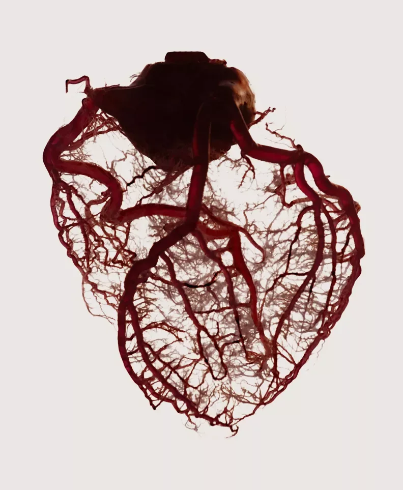 Anatomy graphic of the heart and its vascular system shown before EECP treatment