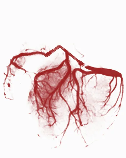 Cardiovascular imaging scan showing vascular structures after EECP treatment