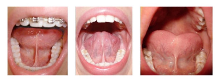 Clinical examples of tongue restrictions (ankyloglossia) addressed by orofacial myofunctional therapy