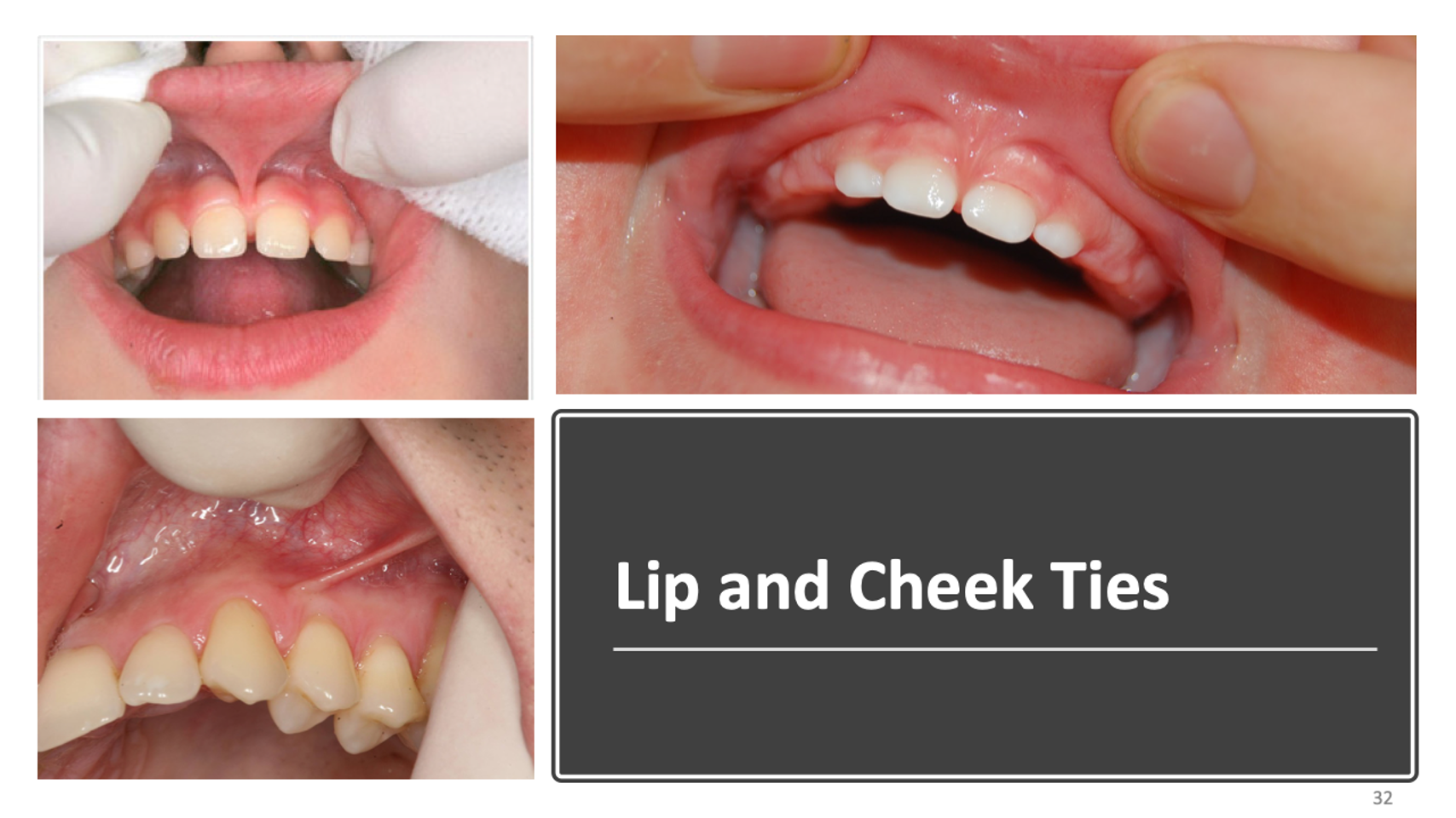 Educational diagram showing lip and cheek ties and their relationship to tongue function and myofunctional therapy