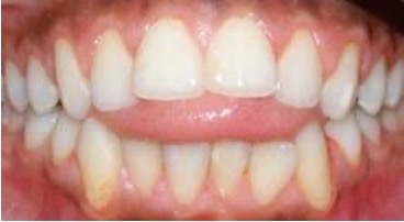 Tongue thrust image showing the improper swallowing pattern addressed by myofunctional therapy