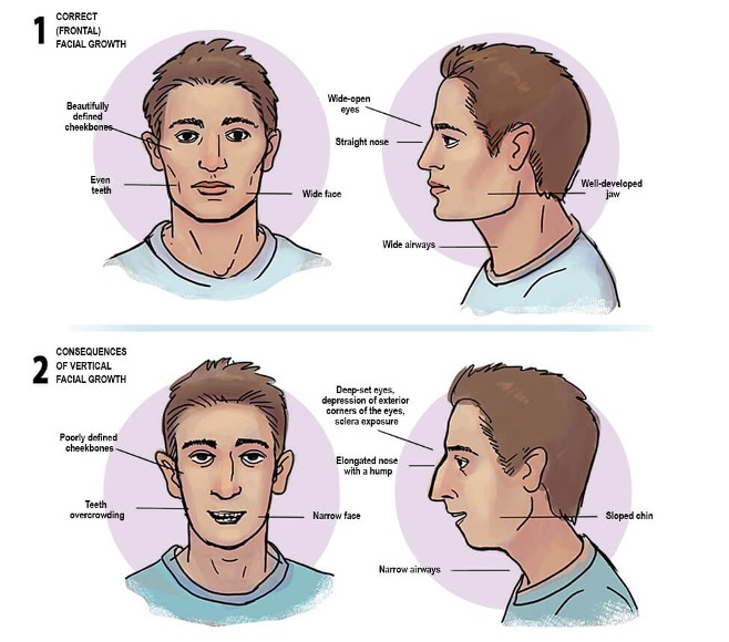 Facial growth comparison showing how myofunctional habits affect oral and facial development